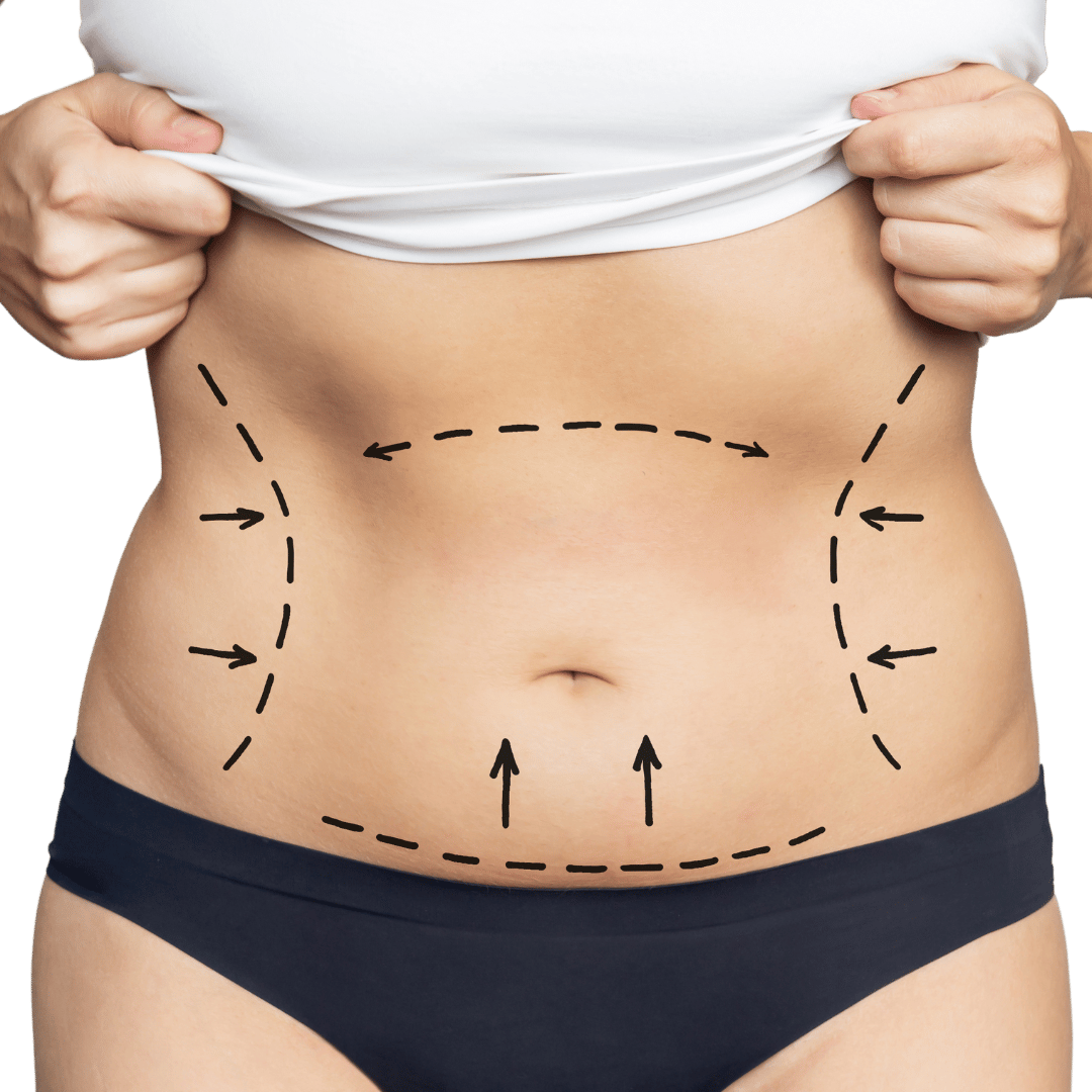 Abdominoplastia